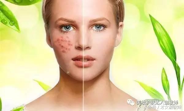 激素脸调肤期间大爆发,激素脸该怎么办才能彻底解决