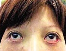 做眼袋后下眼睑外翻有办法解决吗,眼睑外翻怎么办