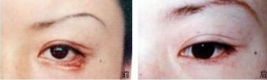 上眼睑轻微外翻有办法治疗吗,眼睑外翻治疗方案