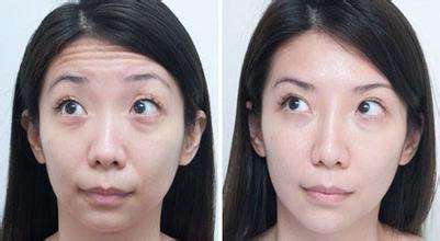 6个小窍门巧妙去除抬头纹,从小就有抬头纹怎么消除简单方法