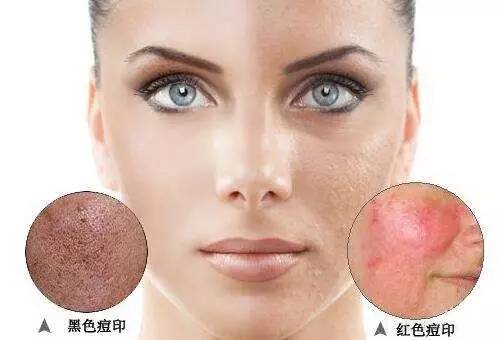 什么医美项目快速有效祛痘印,积雪苷霜软膏祛痘印多久有效