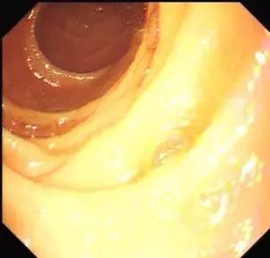 胃镜预处理流程,胃镜内镜手术全流程