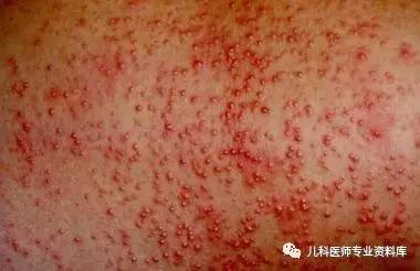 痱子疹子怎么治,大人痱子和热疹