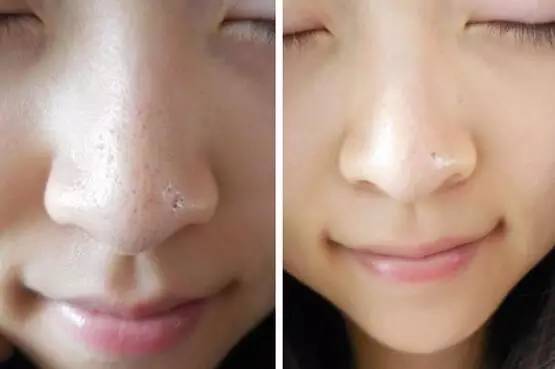 有效去黑头的方法让你摆脱草莓鼻,去黑头小妙招种草
