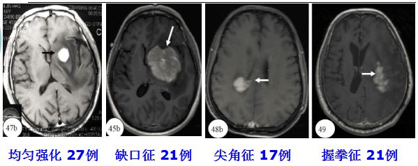 医学干货：瘤样炎性脱髓鞘病与胶质瘤、PCNSL临床、影像鉴别