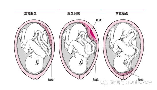 产妇最危险的是什么羊水栓塞,什么情况下产妇会得羊水栓塞