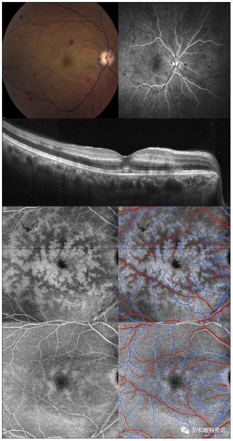 文摘速递丨横看成岭侧成峰,BC扫描各不同—PAMM的enface-OCT影像
