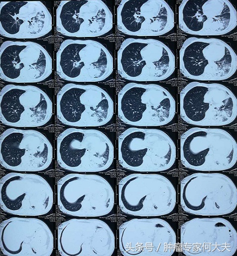 73岁老人得肺癌不治疗能活多久,77岁老人癌症晚期忽然喘不过气