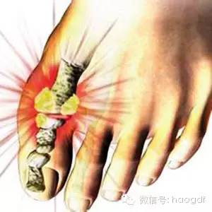 手指疼痛提示4种全身病变,手指疼痛是大病前兆