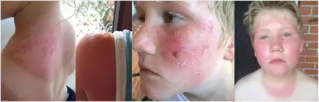 儿童涂防晒霜之前需要涂防晒霜吗,香蕉船防晒霜晒伤事件