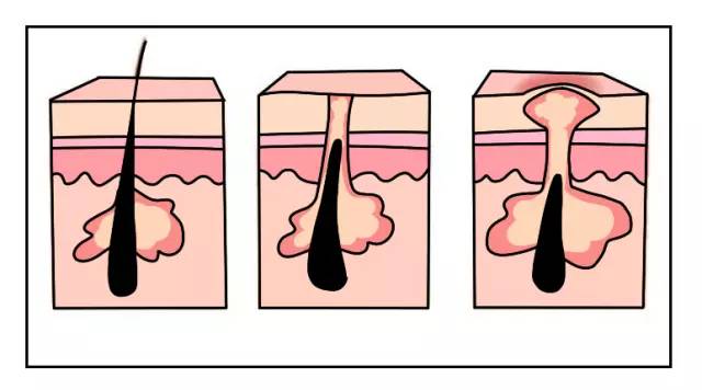 第二天要穿吊带如何解决背后痘痘,后背有痘痘穿吊带的急救办法