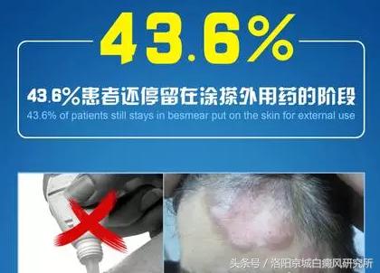 白癜风数据,白癜风正在处于发展高峰期怎么办