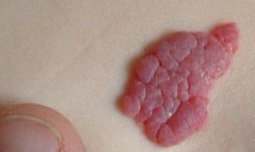 孩子头上血管瘤晒太阳,血管瘤激光后可以晒太阳吗