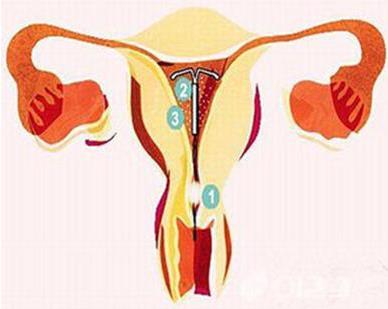 上环就是刮子宫吗,上环真的好吗