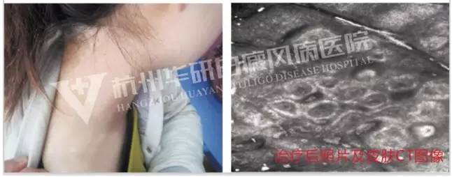 10岁女孩被妈妈查出白癜风,花季少女患白癜风真相