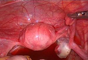 女汉子黄体破裂历险记