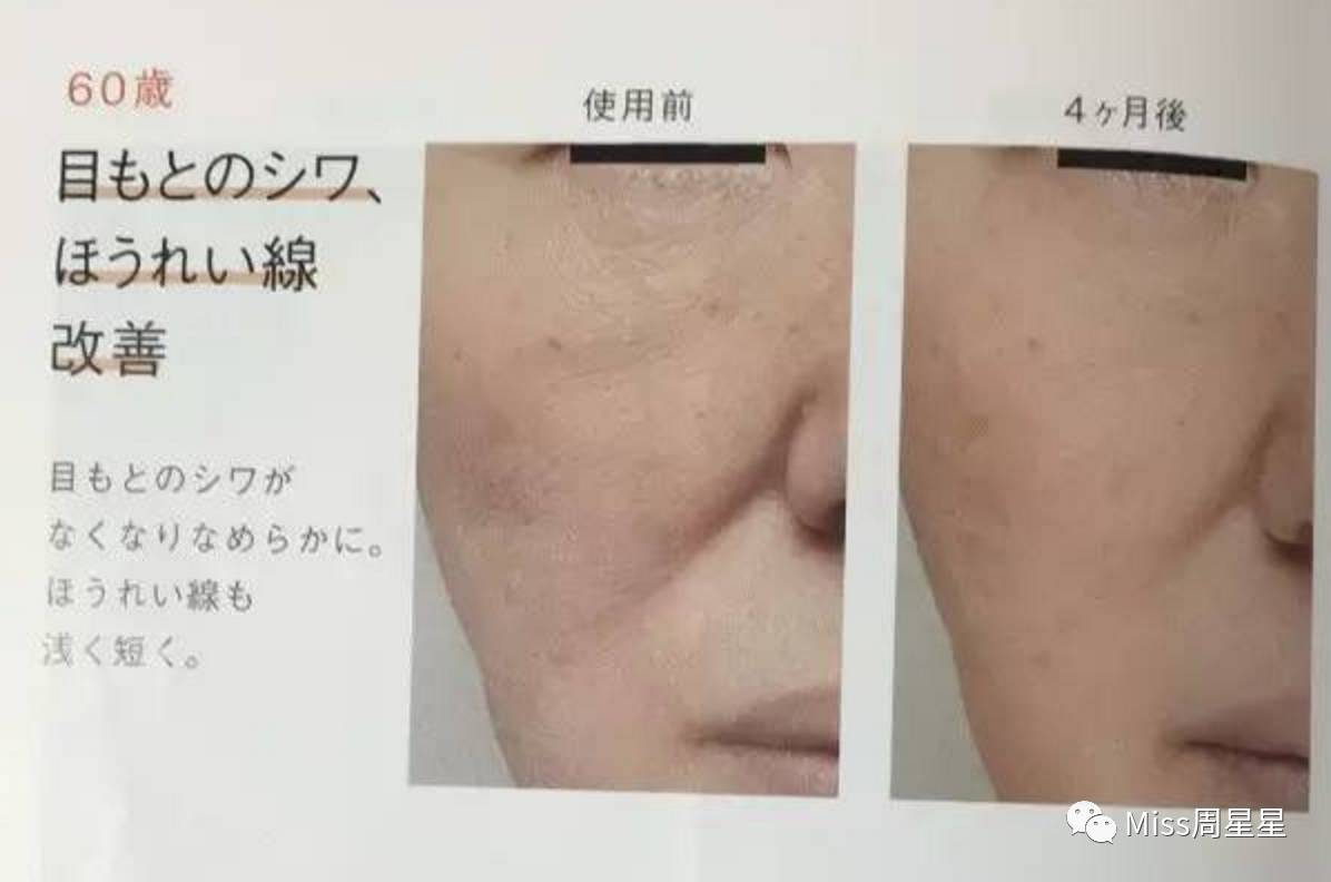 射频类美容仪能去除法令纹吗,改善抬头纹和法令纹的美容仪