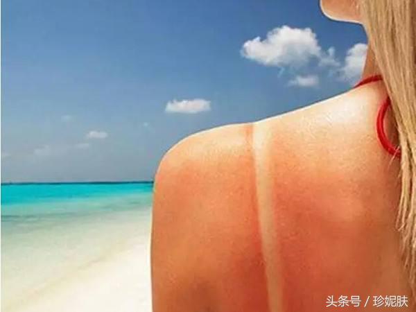 晒后第二天如何修复,晒后72小时修复全攻略