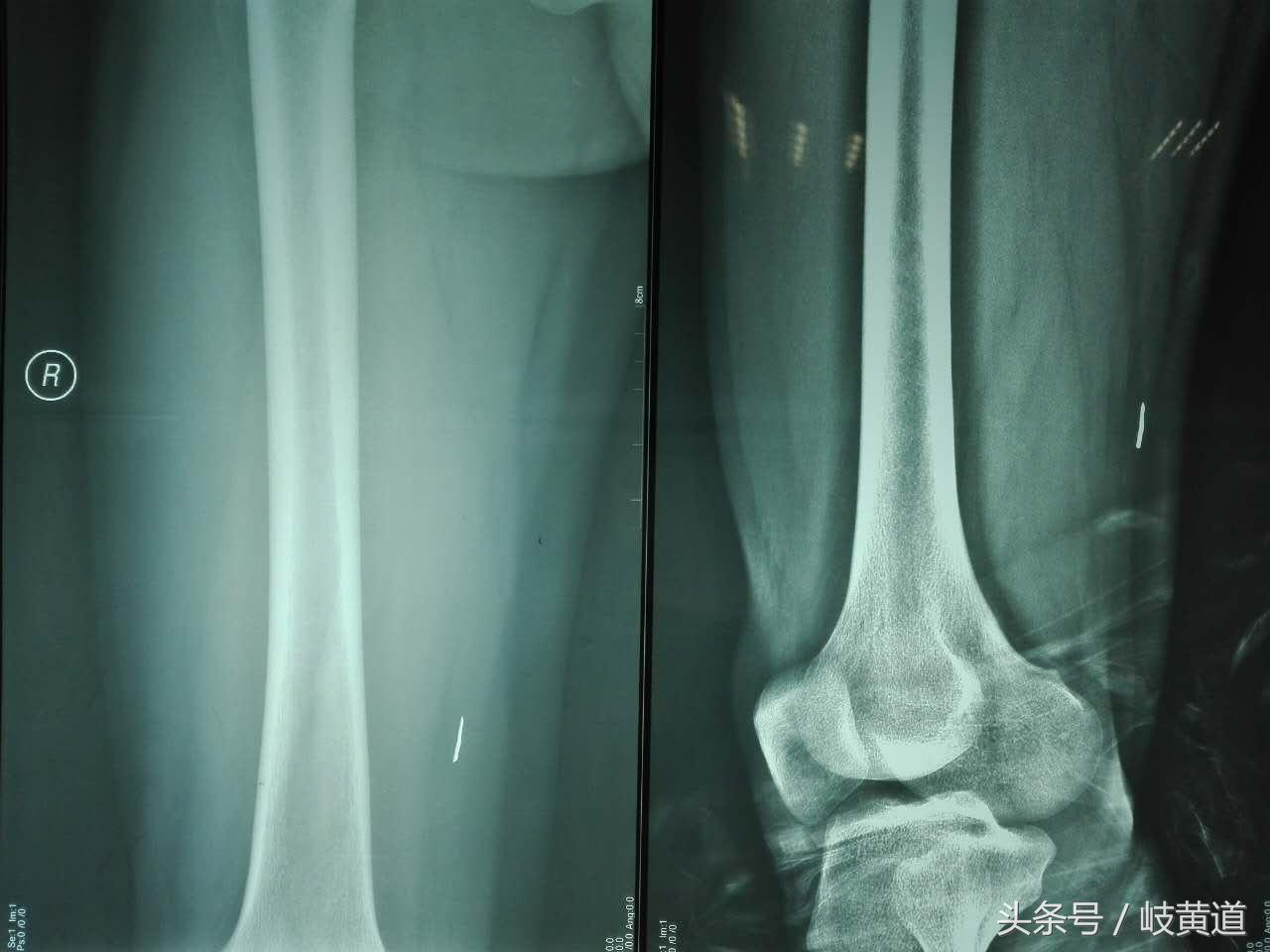 钢渣扎进男子大腿 医生手术2小时取出