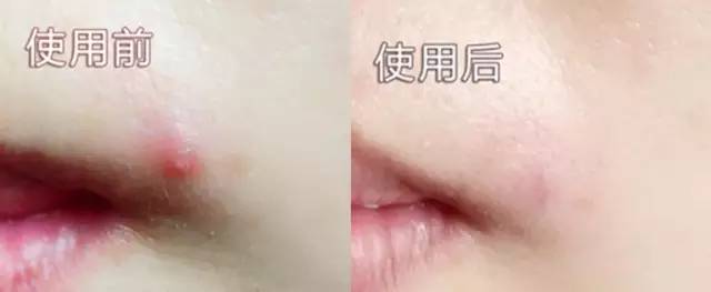 夏天痘痘快冒出来怎么办,战痘到底5个预防痘痘的小秘诀