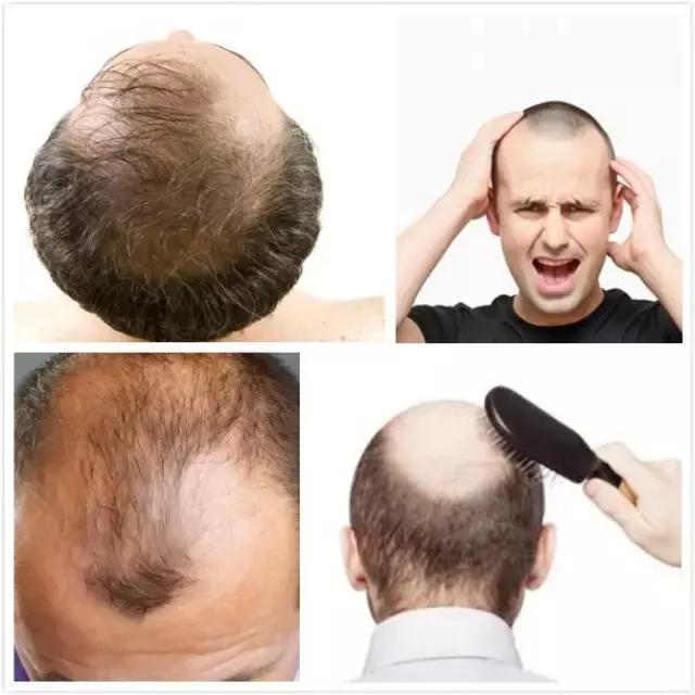 每天梳头100下反而掉发更严重了,怎么一梳头就掉发呢