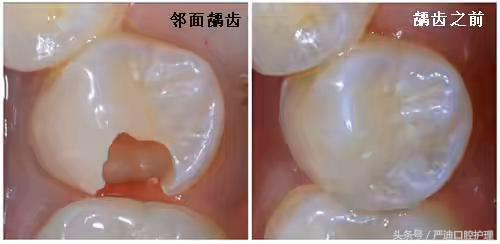 不管吃什么食物都塞牙如何解决,不管吃什么都塞牙怎么办