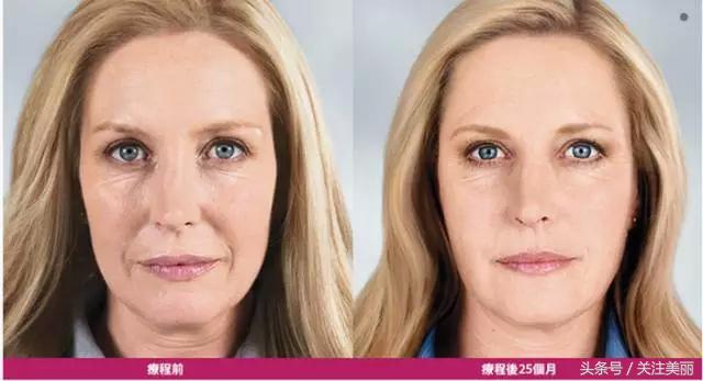 玻尿酸填充真的会好看吗,玻尿酸填充是不是越来越丑