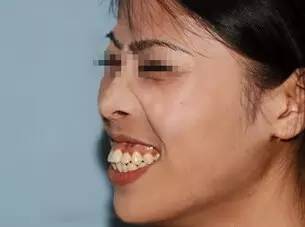 爱笑的人运气不会差牙齿黄,爱笑的人牙齿不好