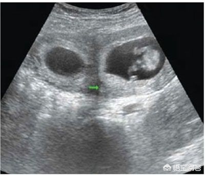 上次检查还好好的双胞胎,这次咋就变单胎了?我的胎儿去哪儿了?