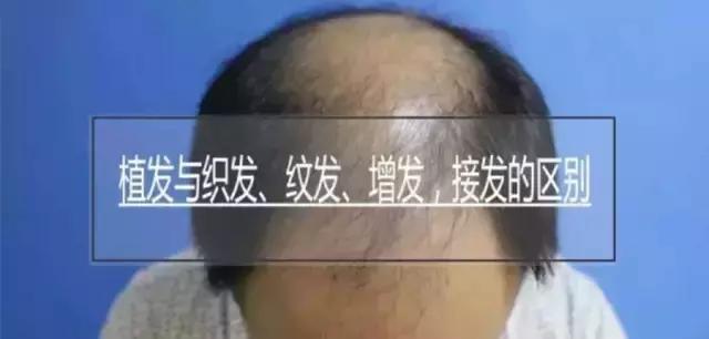 有白发植发和假发哪种好,植发和补发增发哪个好
