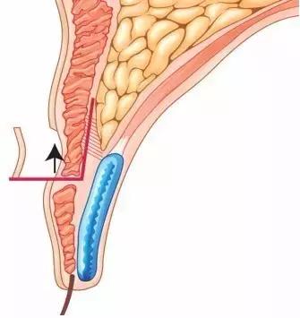 拯救三眼皮的方法,术后出现三眼皮算手术失败吗
