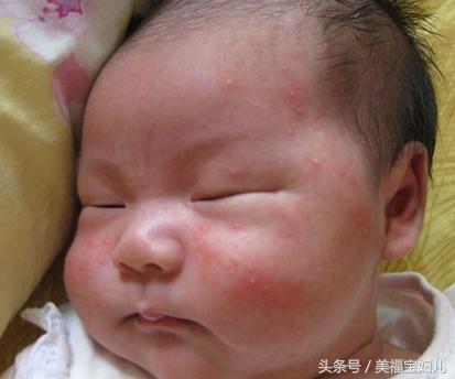 湿疹皮肤瘙痒不要慌用对方法,宝宝得了湿疹怎么处理好得快