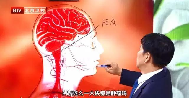 颅底恶性肿瘤原因,脑部肿瘤会导致鼻出血吗