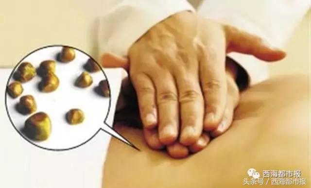 青海人胆结石,胆结石偏爱哪些人