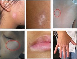 原来白癜风不治疗的危害有这么多，这些危害你都知道吗？