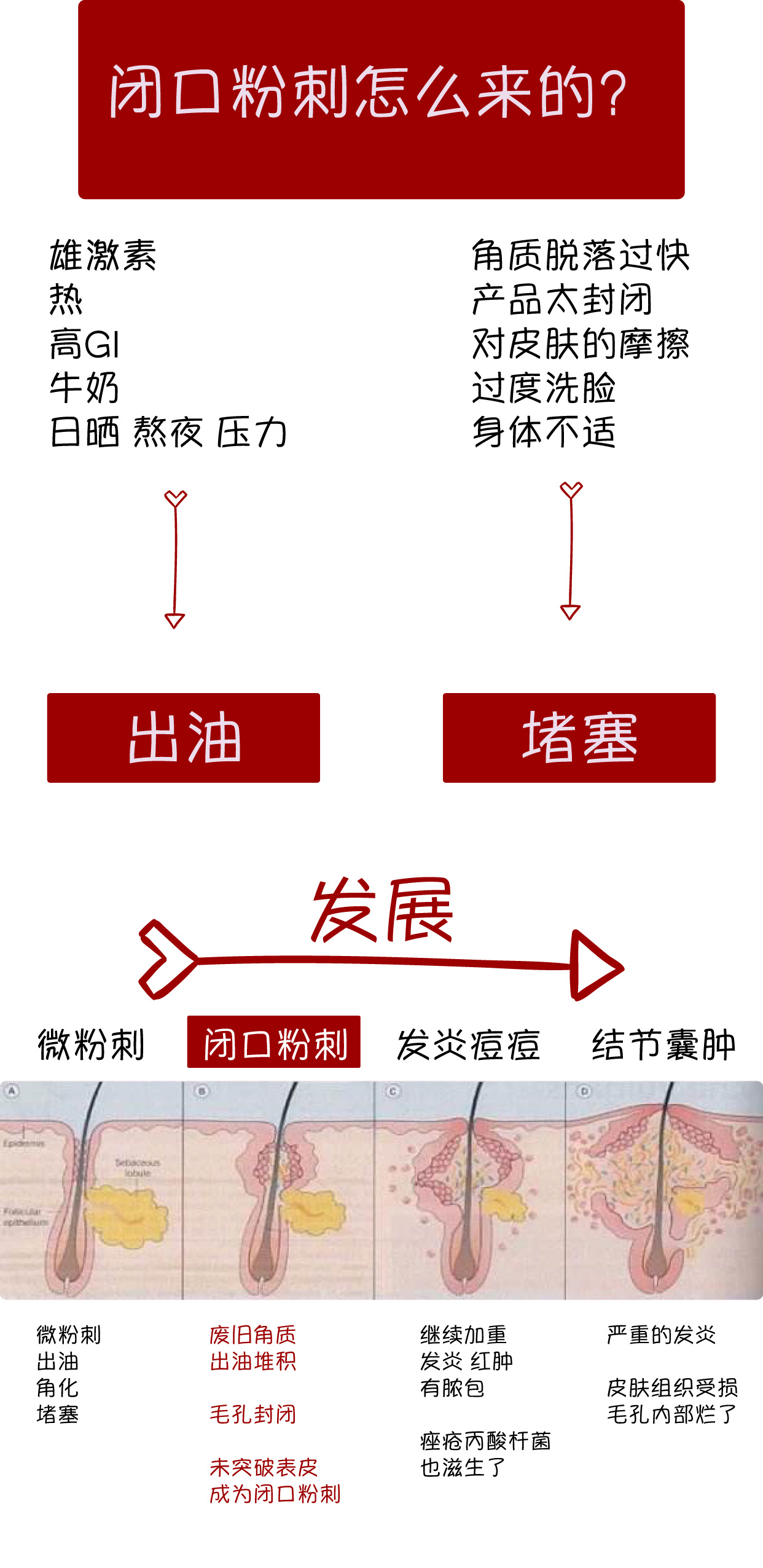 孩子长闭口粉刺怎么办,闭口粉刺总是长怎么办呢