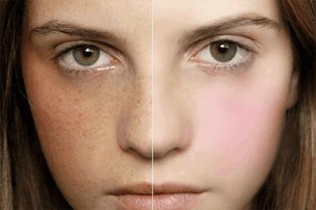 孕期蝴蝶斑怎么祛除,孕期怎样防止斑点加重