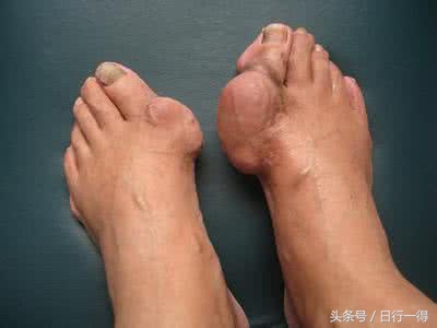 痛风风湿小常识,实习日志骨科个人小结