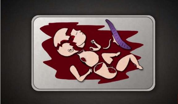 堕胎手术详细流程,女性堕胎手术的可怕真相