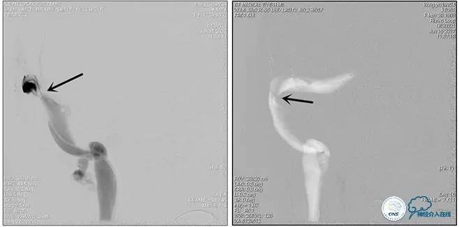 脑静脉窦狭窄做支架危险吗,静脉窦狭窄做支架后多久恢复