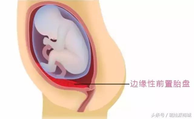 孕妇胎盘低怪谁,孕妇检查胎盘低是怎么回事