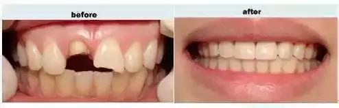 牙齿楔状缺损疼痛怎么办,儿童牙齿有缺损怎么治疗