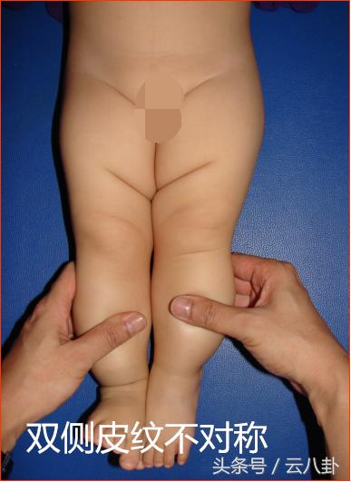 小孩双腿关节不对称,幼儿腿关节有响声挂什么科