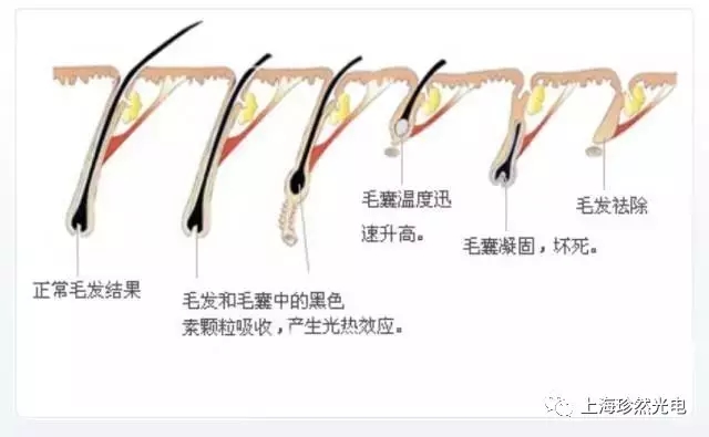 opt脱毛仪真的能脱干净吗,效果稳定opt脱毛仪