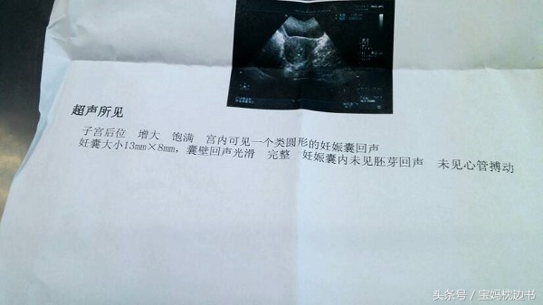 b超检查没有明显胎心是什么原因,b超没胎心误判几率