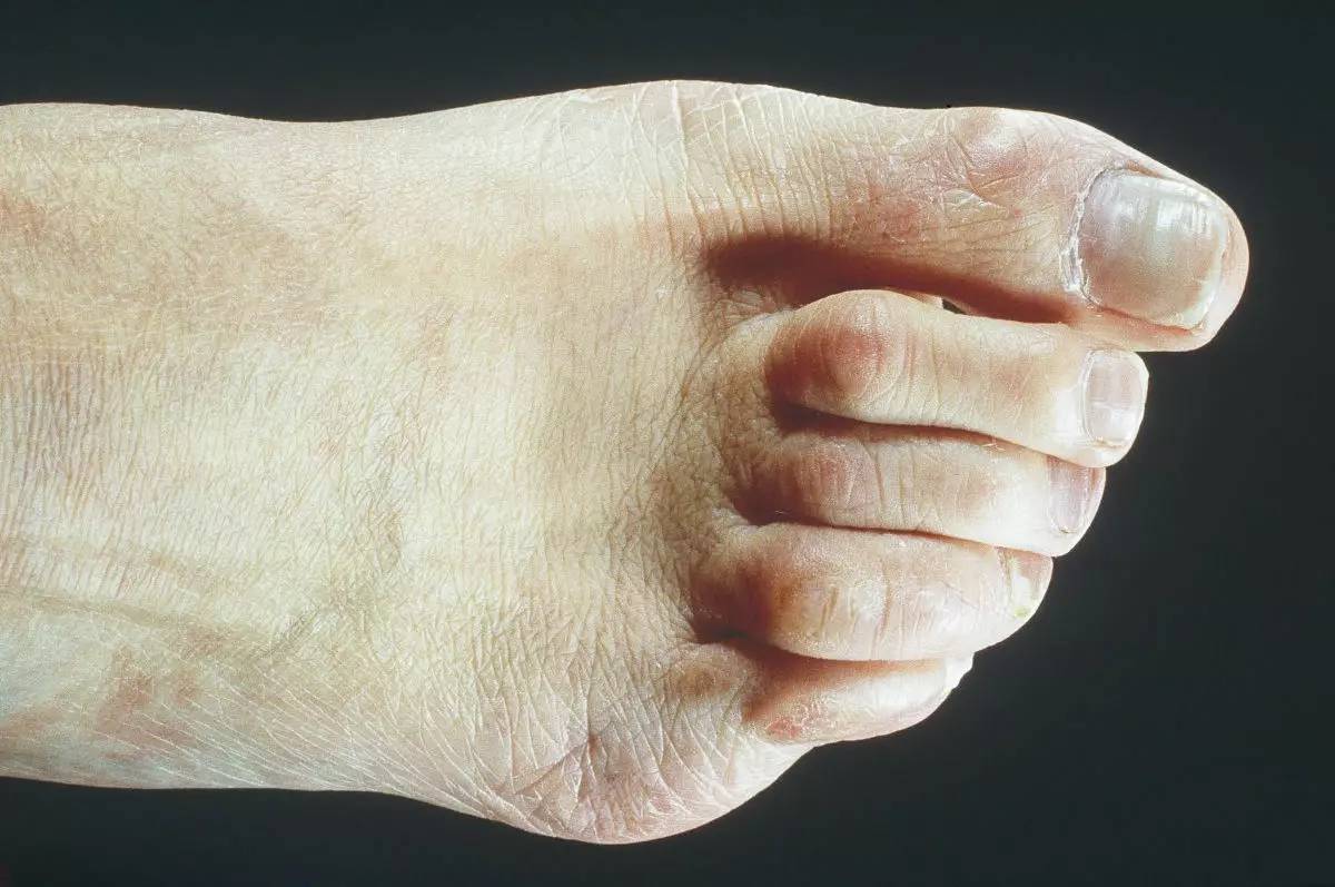 鞋子前面顶脚怎么办,鞋子顶脚趾头很痛怎么办