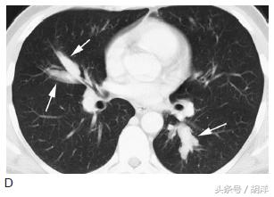 有一种真菌，专门在肺部原有疾病产生的空洞里长小球，消不掉，咳不出，有时候会引起致命大出血