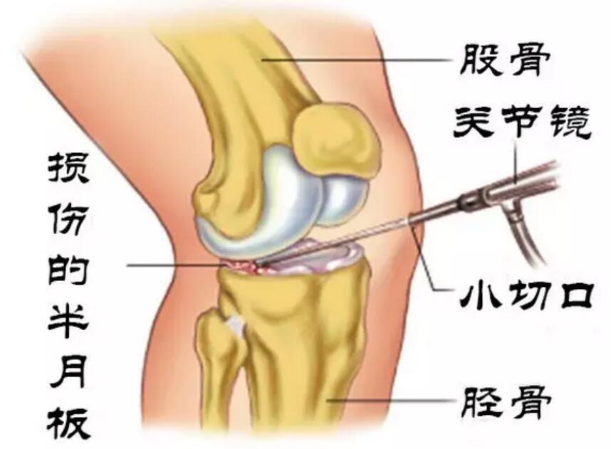 半夜半月板损伤膝盖有积液,膝盖半月板损伤要怎么治
