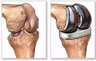 北京大学第一医院张道俭,讲解“走路不疼,上下楼疼”是肿么回事?