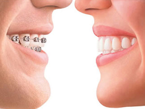 牙齿矫正后需要戴多久保持器,牙齿矫正过后需要戴多久的保持器